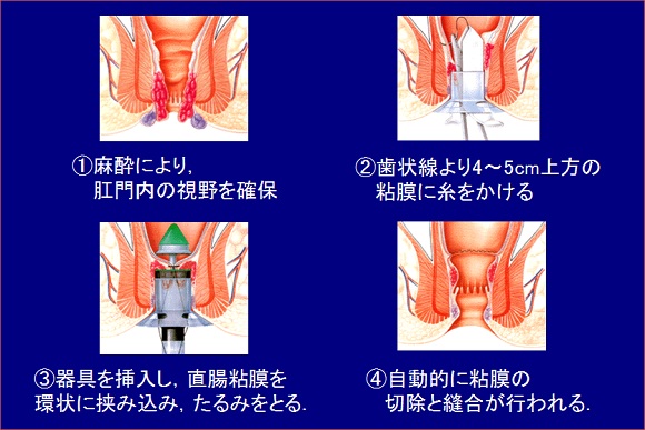 pph法
