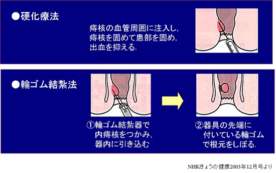 輪ゴム法